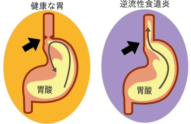 胃酸が逆流しないようにするためには