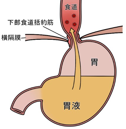 逆流性食道炎のメカニズム