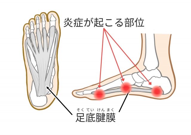 足底腱膜の炎症が起きる部位